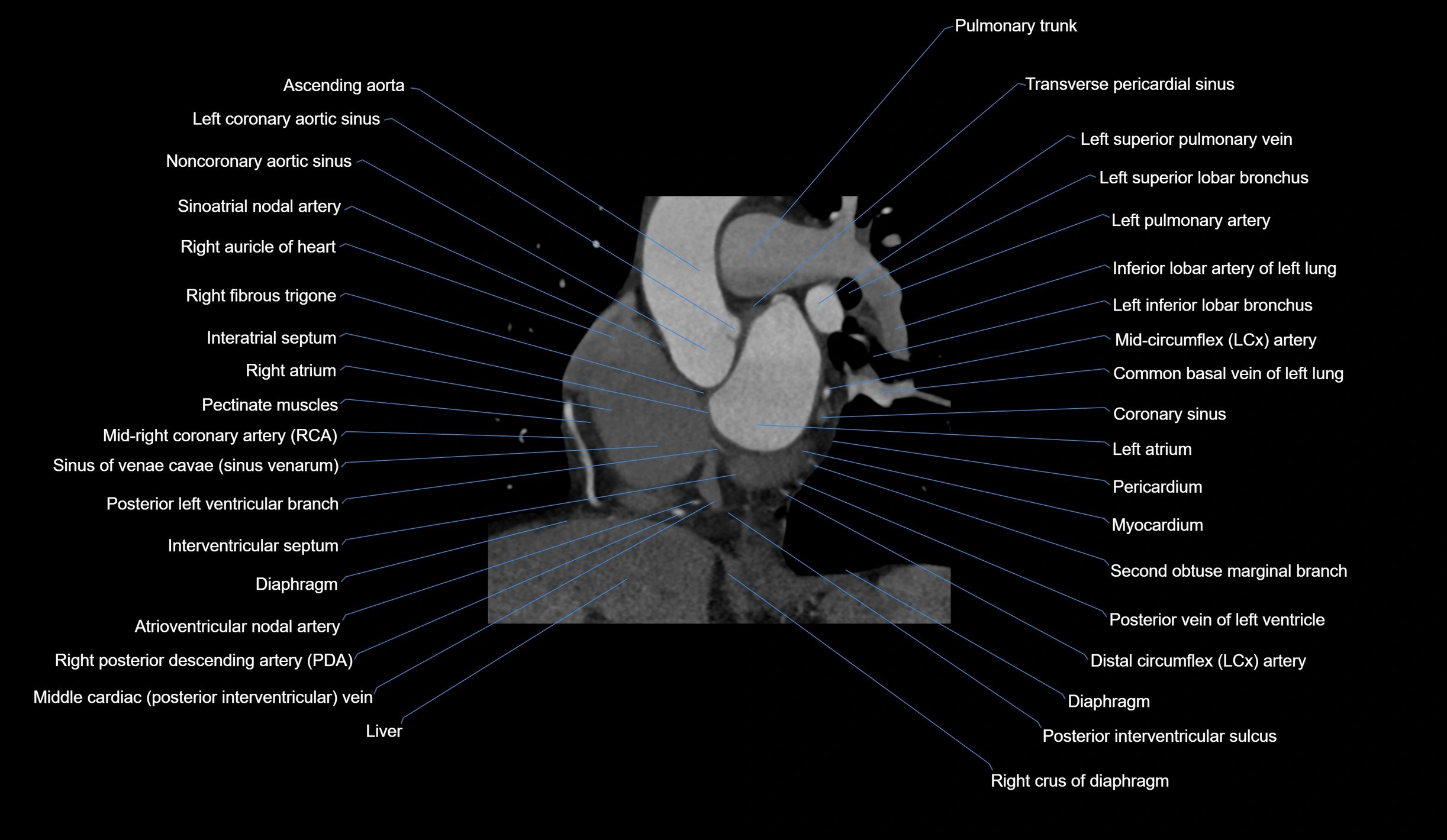 CT heart (coronary angiogram) short axis view  cross sectional anatomy labelled radiology image-00018.webp